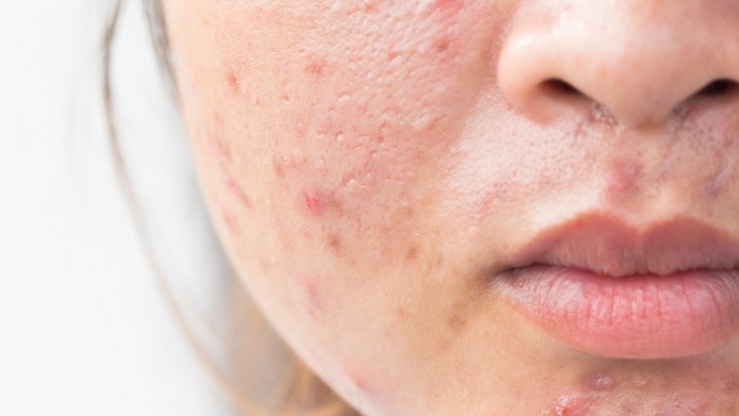 Các bước chăm sóc da mụn tại nhà cho người bận rộn