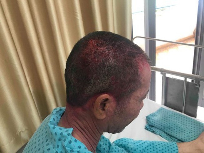 di ung thuoc nhuom toc benh nhan bi phong rop da dau co va mat