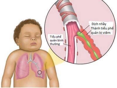 tre nho tho kho khe la dau hieu cua benh gi