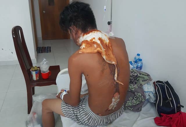 dang an mi tom thanh nien bi chi ruot tuoi nuoc soi vao dau