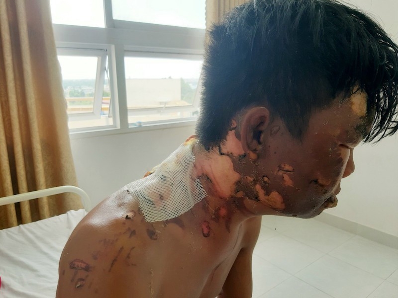 dang an mi tom thanh nien bi chi ruot tuoi nuoc soi vao dau