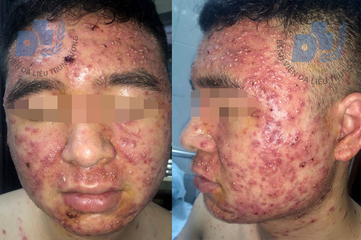 tri mun trung ca bang thuoc nam thanh nien bi mun mu lan khap mat