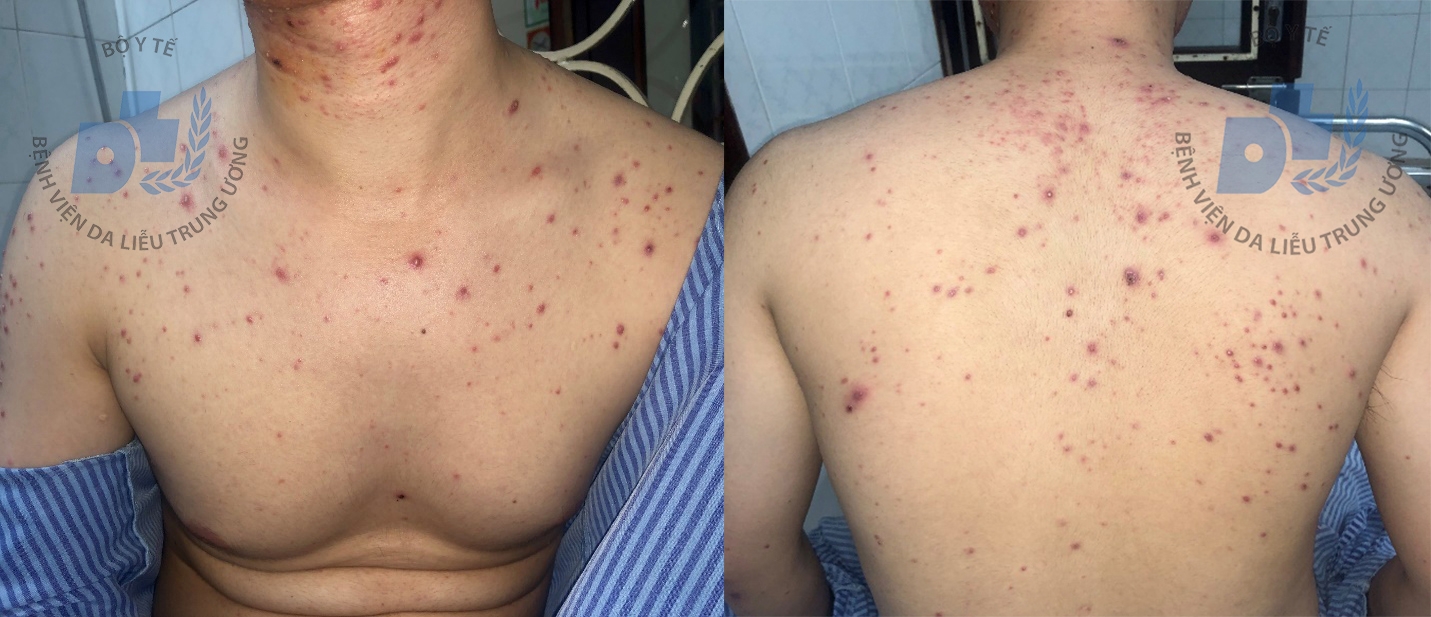 tri mun trung ca bang thuoc nam thanh nien bi mun mu lan khap mat