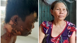 nguyen nhan em trai bi chi tuoi nuoc soi vao dau do hon lao