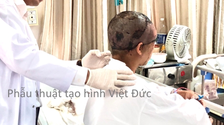 nga vao noi lau be 2 tuoi bi bong nang toan bo co nguc