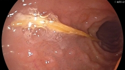 an chao luon ngoai hang be 13 thang tuoi bi hoc manh thep dai 2cm