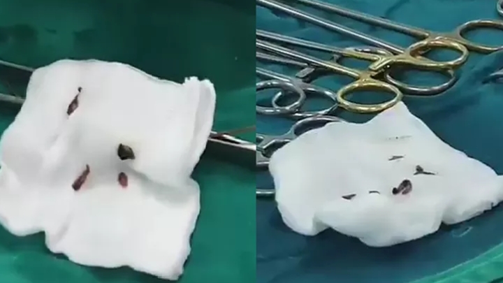 clip hang nghin ki sinh trung luc nhuc trong ong mat nguoi an goi ca