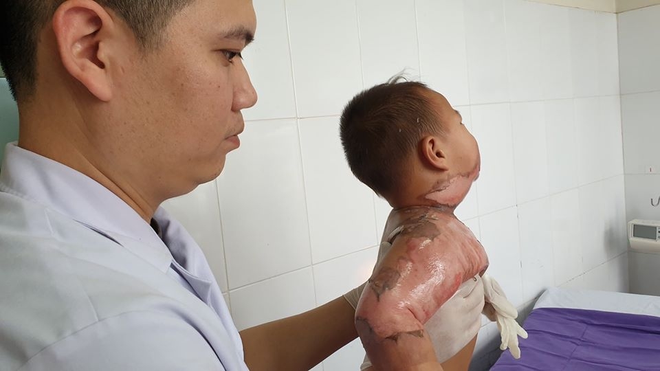 nga vao noi lau be 2 tuoi bi bong nang toan bo co nguc