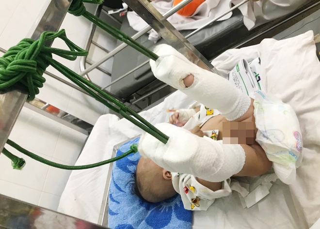 be trai 4 thang tuoi nghi bi cha danh gay chan xuat huyet nao