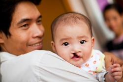 Lịch phẫu thuật nụ cười tháng 5/2019, đăng ký ở đâu, cách nào?