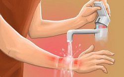 Điều trị vết bỏng bằng thuốc nam, bé trai 9 tuổi suýt hoại tử chân