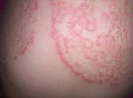 WHO lần đầu tiên xác định các bệnh về nấm là mối đe dọa với sức khỏe con người
