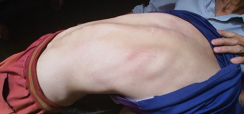 Nghệ An: 17 năm sống chung với căn bệnh viêm cột sống dính khớp vì không có tiền chữa trị