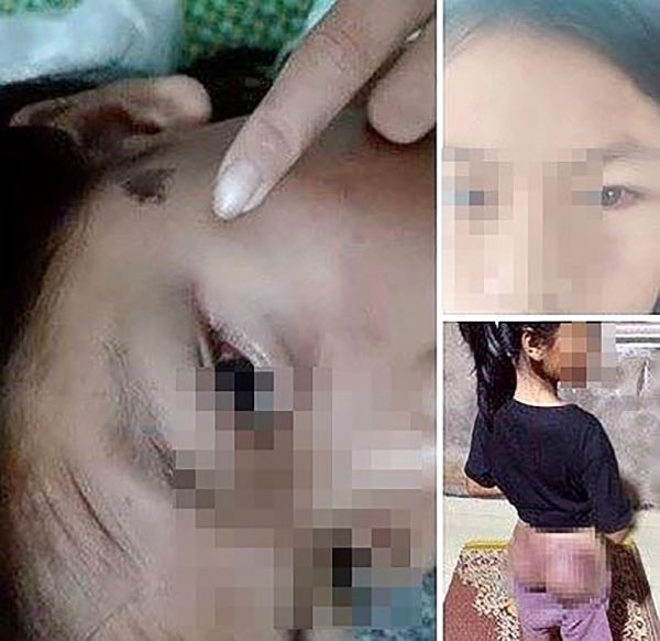Xác minh vụ công an viên đánh bé gái 12 tuổi bầm tím phan no cong an vien dung day cao su danh bam tim mong be gai 12 tuoi phai nhap vien