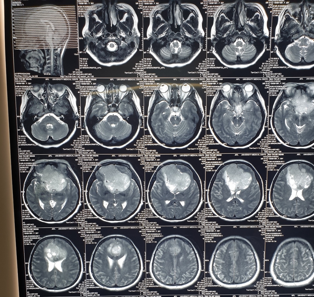 4938 hinh ynh khyi u tren phim mri
