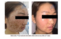 Sử dụng mỹ phẩm trôi nổi trên mạng: Tiền mất, tật mang