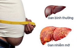 Bệnh gan nhiễm mỡ không do rượu: Nguyên nhân và cách điều trị