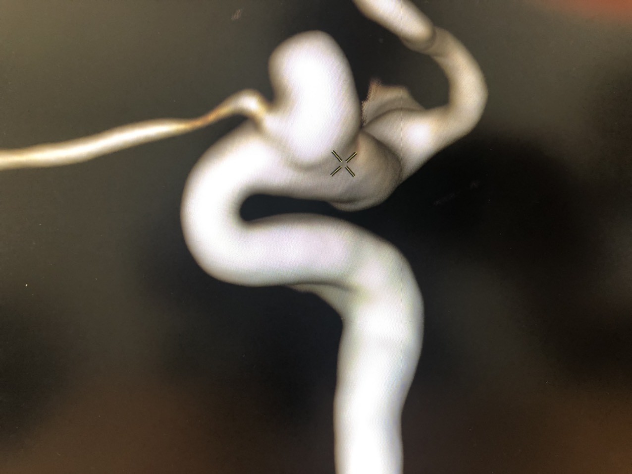 Túi phình động mạch não được chẩn đoán sớm trên máy chụp cộng hưởng từ MRI Tesla 3.0