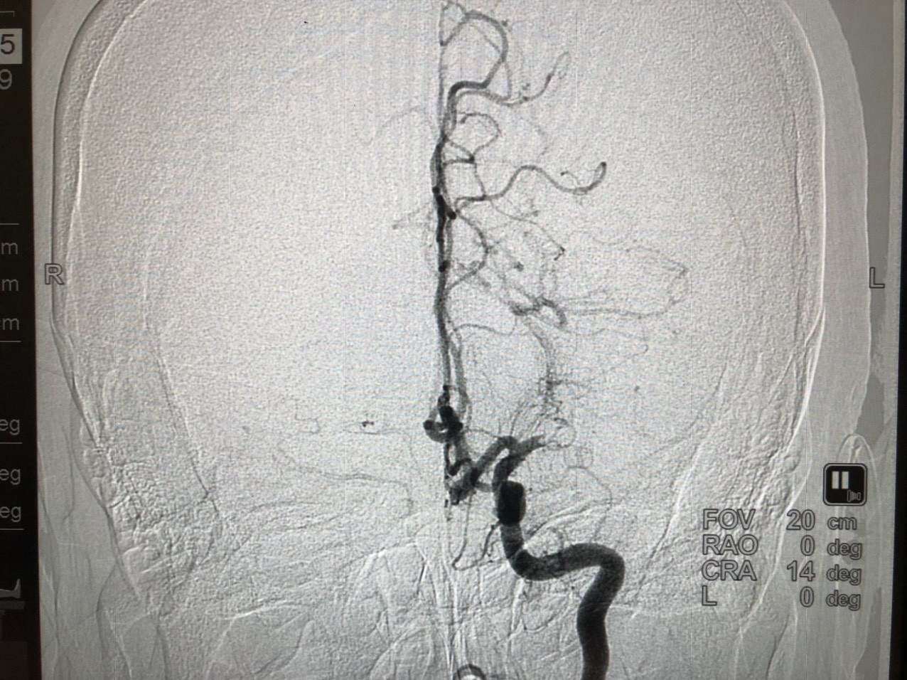 Hình ảnh tắc mạch máu não được chụp trên hệ thống chấn đoán hình ảnh DSA cao cấp của BV Vinmec Đà Nẵng
