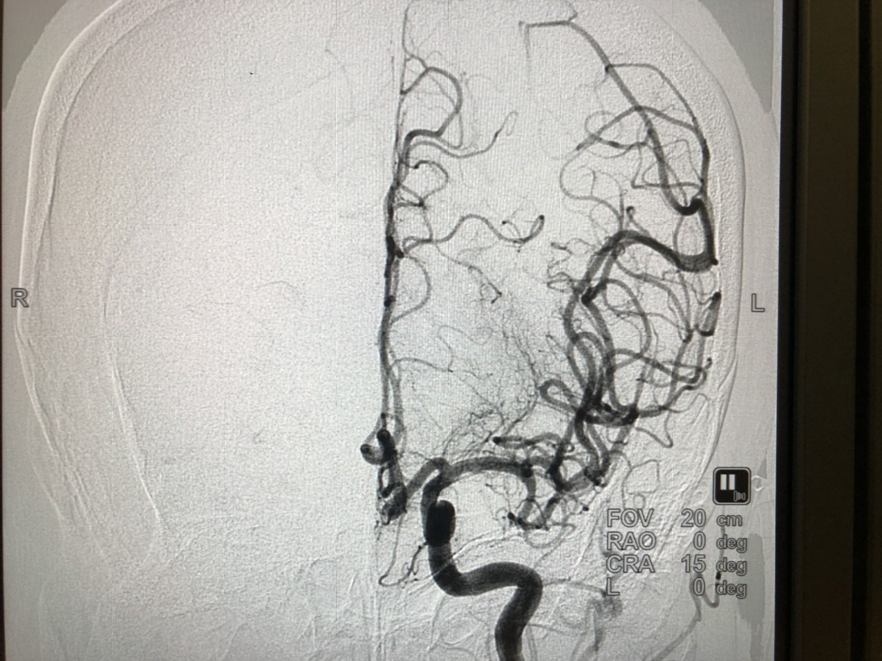 Hình sau khi lấy cục huyết khối ra và mạch máu đã đc tái thông