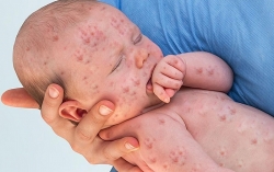 Châu Phi: 3 tháng đầu năm 2019 tăng 700% ca sởi so với cùng kỳ