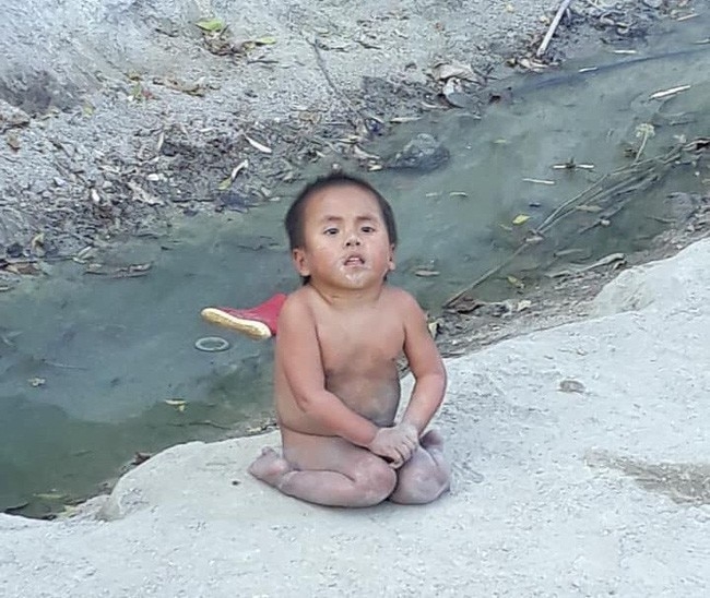 cuoc song hanh phuc cua em be muong lat liet 2 chan sau 3 nam duoc nhan nuoi