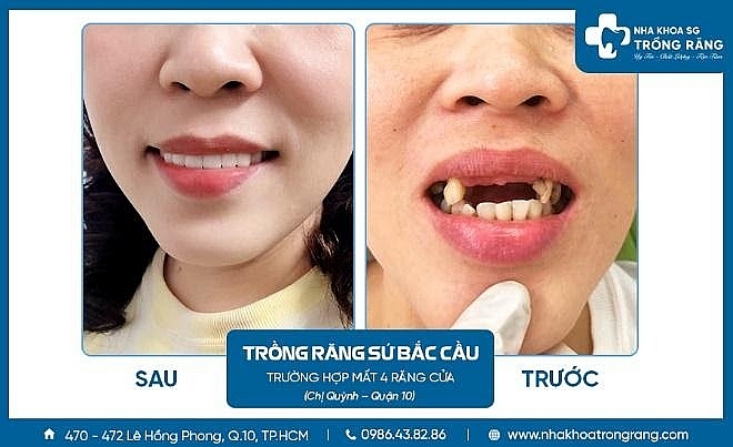 Nha khoa trồng răng Sài Gòn – Địa chỉ trồng răng uy tín, chất lượng