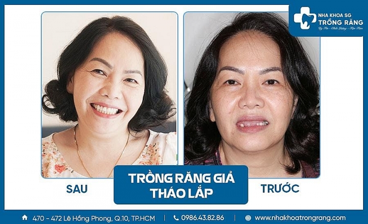 Nha khoa trồng răng Sài Gòn – Địa chỉ trồng răng uy tín, chất lượng