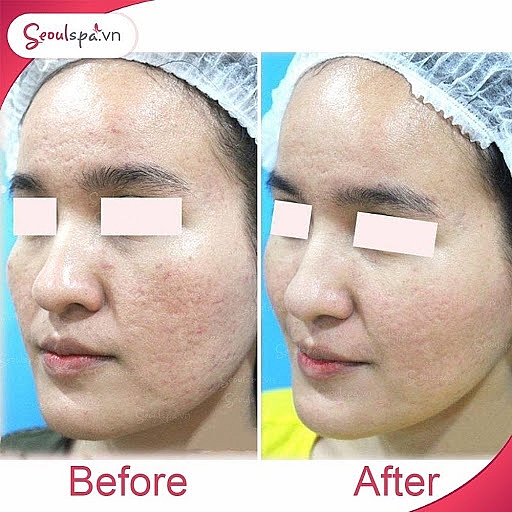 Dịch vụ điều trị sẹo rỗ tận gốc tại Seoul Spa có ưu điểm gì ?