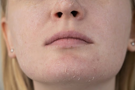 Da khô và thiếu nước: Chăm sóc như thế nào?
