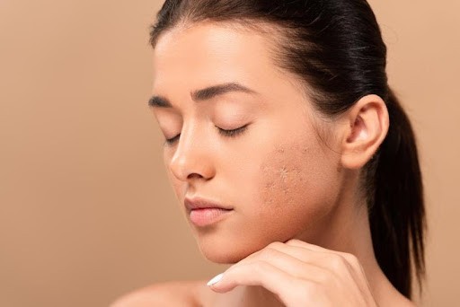 Mụn trứng cá: nguyên nhân, biểu hiện và cách điều trị Mụn trứng cá: nguyên nhân, biểu hiện và cách điều trị