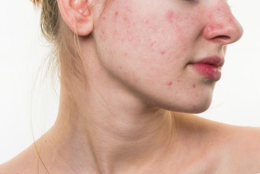 Mụn trứng cá: nguyên nhân, biểu hiện và cách điều trị Mụn trứng cá: nguyên nhân, biểu hiện và cách điều trị
