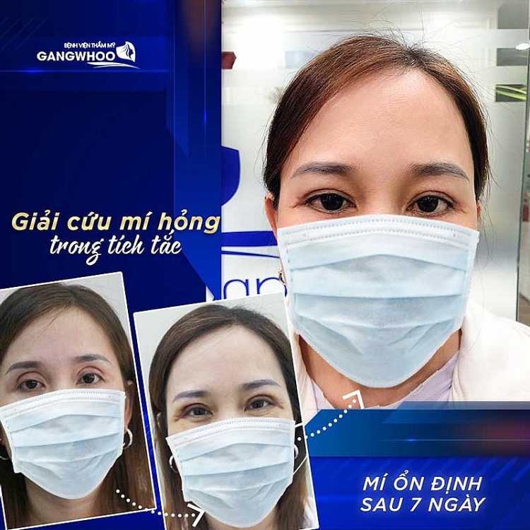 Sửa mí mắt hỏng uy tín tại Bệnh viện thẩm mỹ Gangwhoo