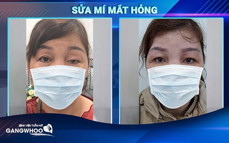 Đôi mắt lấy đi tự tin trong cuộc sống giờ đây đã được khắc phục bởi bệnh viện thẩm mỹ Gangwhoo