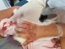 Kỳ tích nối bàn tay gần đứt rời cho bé gái 3 tuổi