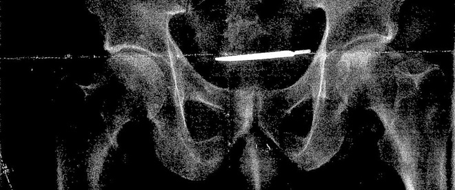 dau bung chong mat nguoi dan ong di kham va phat hien thu khong the ngo den trong bung