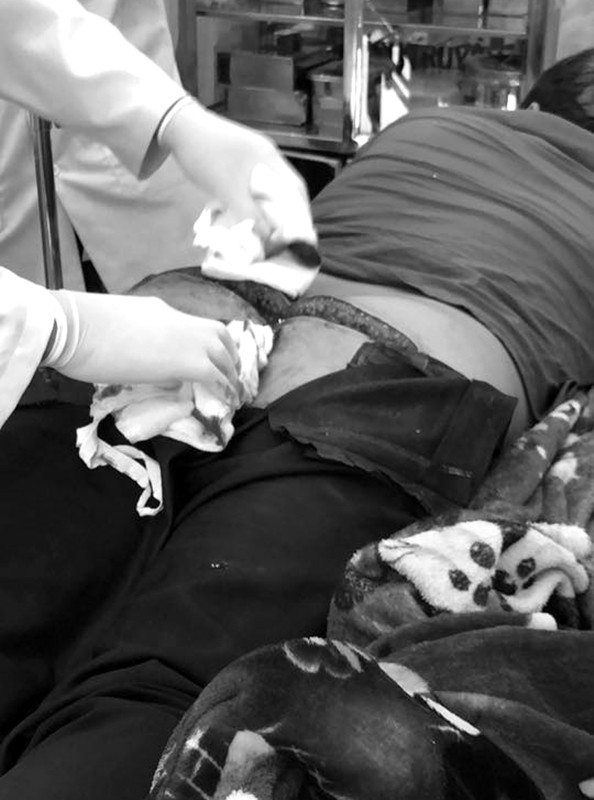 ngoi chom hom di ve sinh nam thanh nien nang gan 100kg bi bon cau cat dut mong