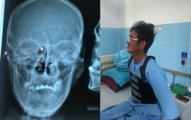 chong say ruou dam chan thuong nu bac si trong luc cho vo de o dong nai