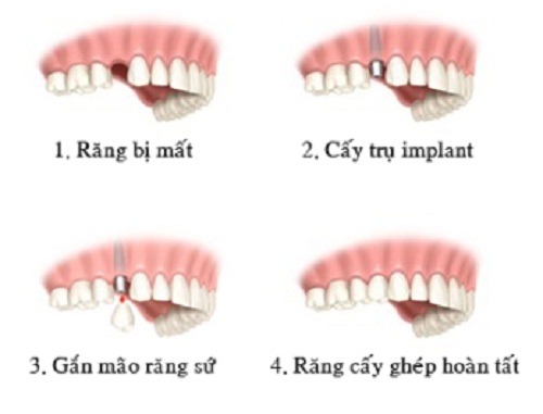 ky thuat cay ghep implant nguyen ham an toan dat tieu chuan quoc te