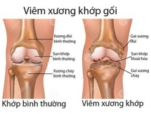 nguyen nhan va nhung yeu to nguy co cua viem khop dang thap bai 1