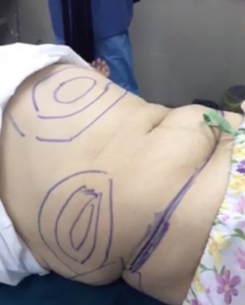 hoi chuyen bac si cat 2 tang mo bung cho a quan buoc nhay ngan can