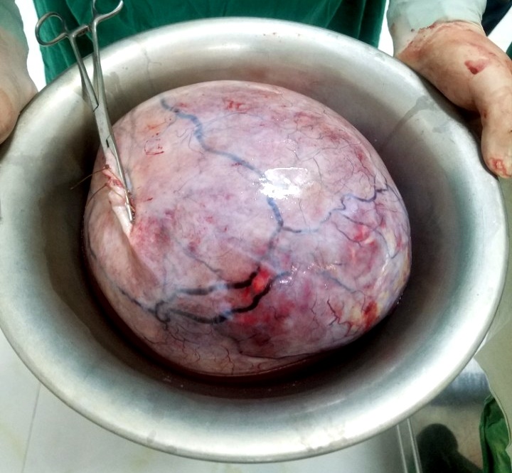 yen bai phau thuat boc tach khoi u nang 55 kg