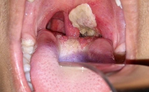 quang ngai ghi nhan 1 truong hop tu vong vi benh bach hau