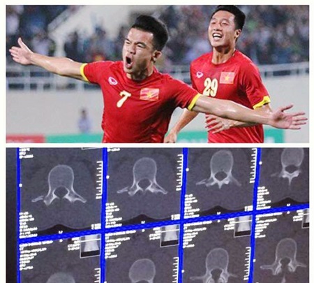 gay hai xuong suon hoang thinh lo hen voi sea games
