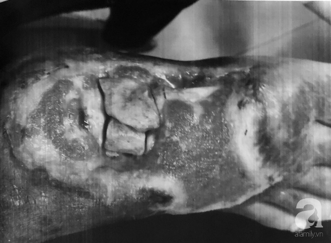 bi ran can khong di vien ma qua 3 thay lang chua chan be gai 13 tuoi bi hoai tu den loi xuong