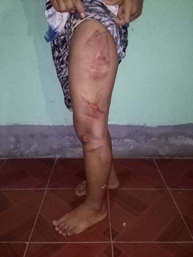 co be 13 tuoi di lam giup viec bi chu nha dung ban la nong bao hanh roi do nuoc soi len nguoi