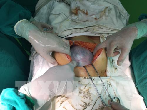 phau thuat thanh cong lay u quai buong trung nang gan 4 kg