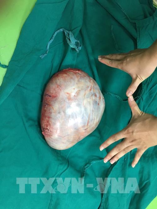 phau thuat thanh cong lay u quai buong trung nang gan 4 kg