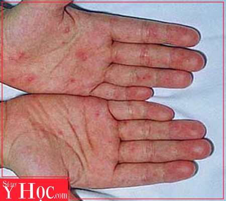 nghien cuu ve nhiem khuan huyet cua viet nam nhan giai thuong alexandre yersin