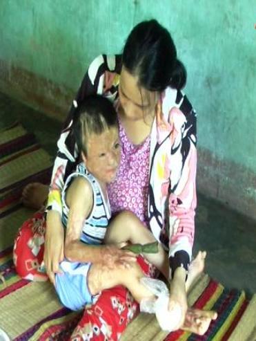 xot thuong so phan dua be bi bong nang tai tinh quang nam